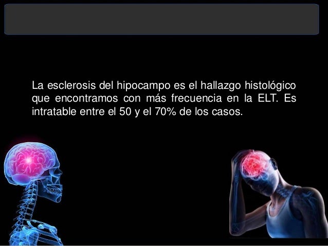 epilepsia del lobulo temporal mesial